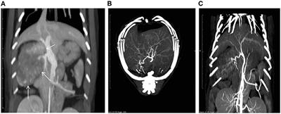 Case Report: Transcatheter Arterial Embolization for the Initial Management of Intra-Abdominal Hemorrhage From a Hepatic Tumor in a Cat